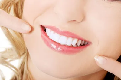 SỨ HT-SMILE